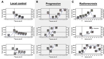 FSRT vs. SRS in Brain Metastases—Differences in Local Control and Radiation Necrosis—A Volumetric Study